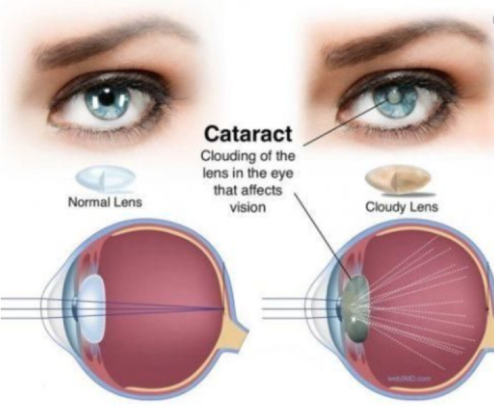 cataractimg